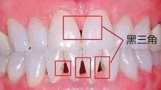 牙缝惊现“黑三角”！究竟有什么内幕？