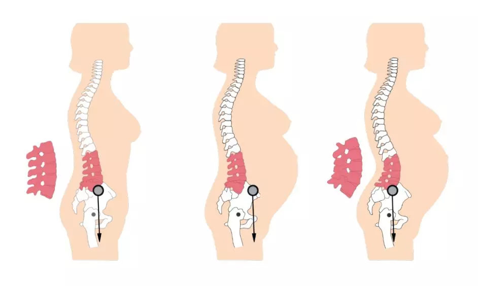 【心至柔母婴健康】生完孩子,你腰背痛吗?