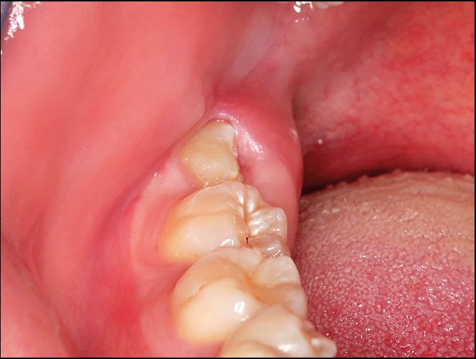 舌向位阻生智齿已部分萌出于软组织,冠部常无骨阻力