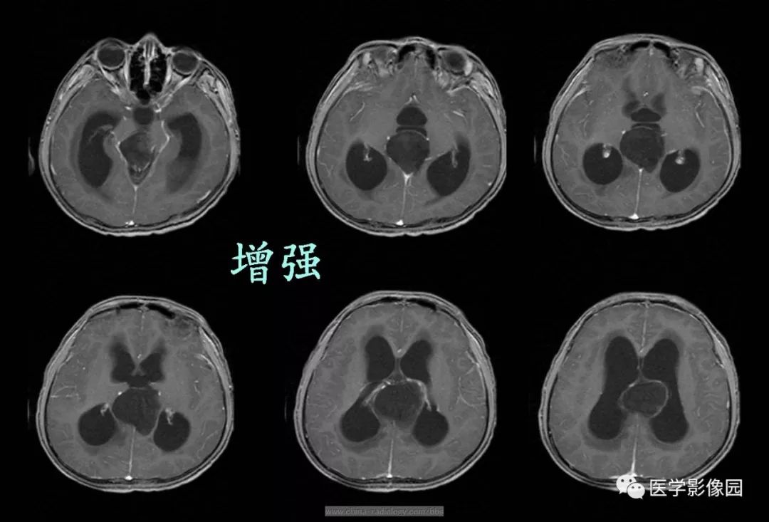 颅内皮样囊肿等你分析读片专栏934期