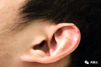 耳廓的大部分都以弹性软骨为支架,更有利于尿酸盐结晶的附着.