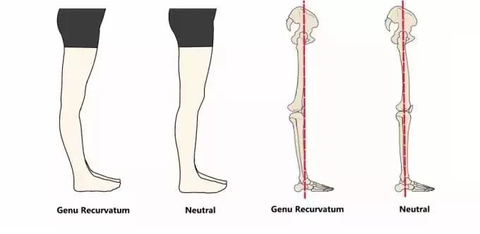 什么是超伸 膝超伸,英文是hyperextended knee 膝反弓,膝关节伸展幅度