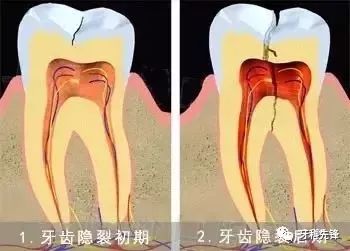 牙齿一吃饭就疼怎么办