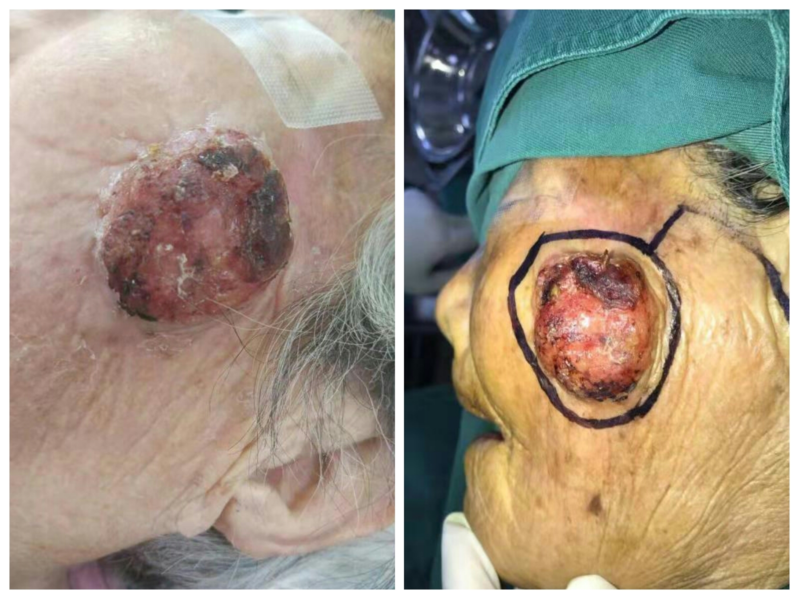 脸上一"黄豆"般疙瘩,抠~抠,变成"鸡蛋 般恶性肿瘤!86岁老太住进