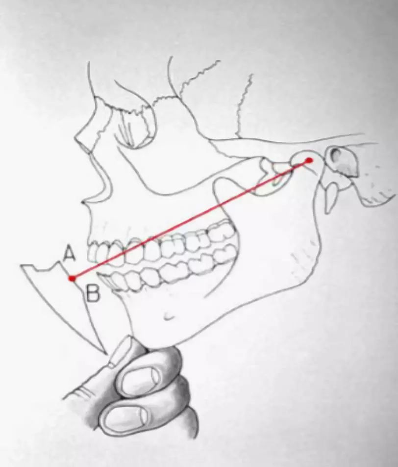 颏点引导法及哥特式弓描记法等,只有正确地确定了颞下颌关节的位置和