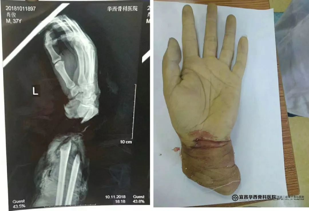 x光片显示患者左手离断