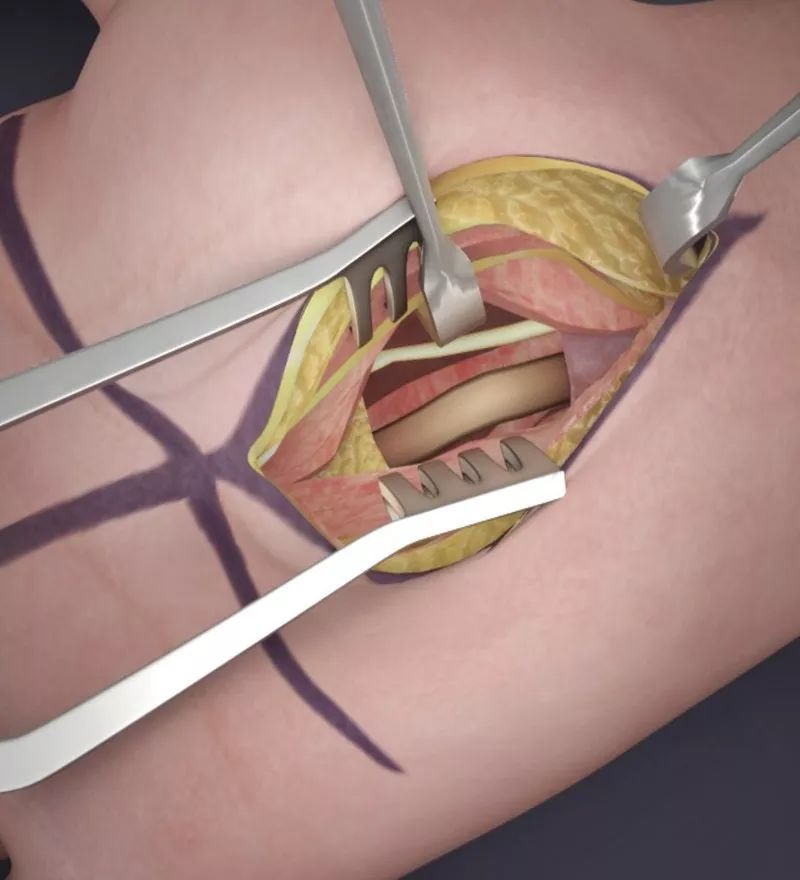 腕管综合征手术关键步骤3d模拟展示
