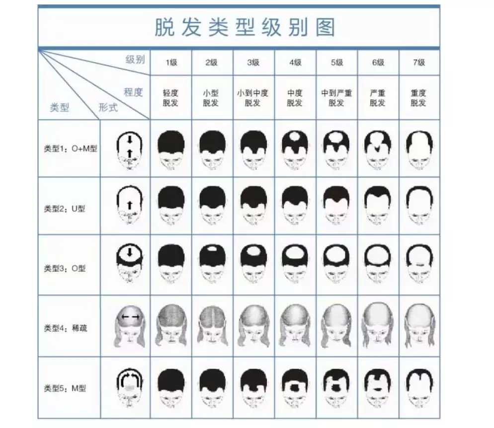 如果脱发现象已经比较严重,可以对照下图,确定脱发等级和类型: 木有