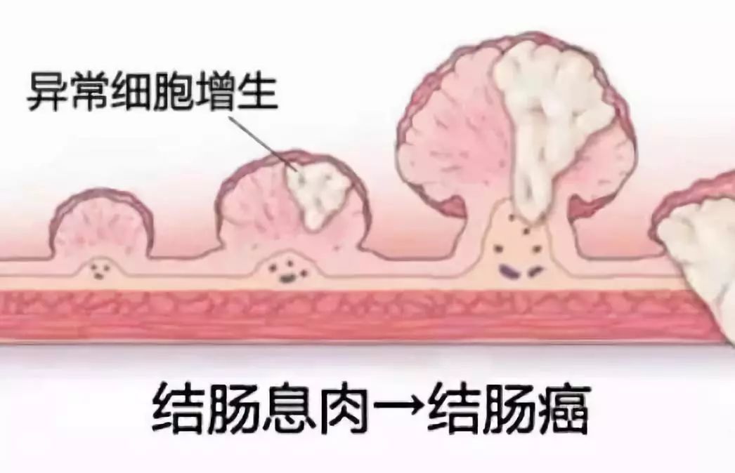 我院特邀潍坊市人民医院专家成功行肠镜下结肠息肉切除术_检查