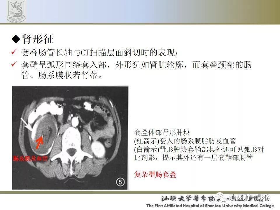 肠套叠影像学诊断