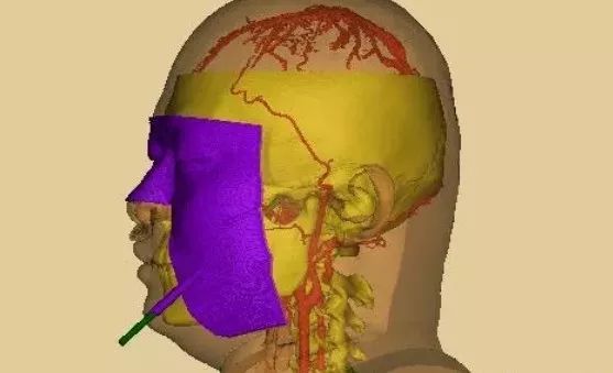 【技术前沿】3d打印在三叉神经痛穿刺治疗中的应用