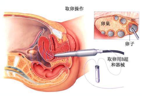 揭秘试管婴儿全过程(附图),看完后心疼女性一万遍_卵子