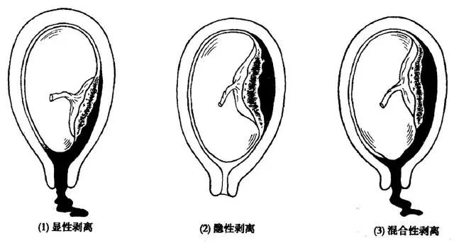 为隐性型;胎盘剥离后血液沿胎膜下行,经子宫颈口向外流出,为显性型;既