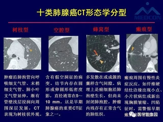 肺癌的ct影像学特征及临床意义 影像天地