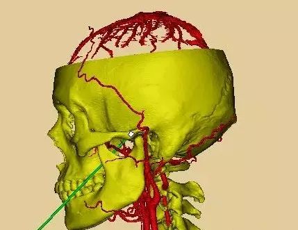 可见穿刺通路及穿刺终点在头部投影利用软件观察卵圆孔体表投影在颧骨
