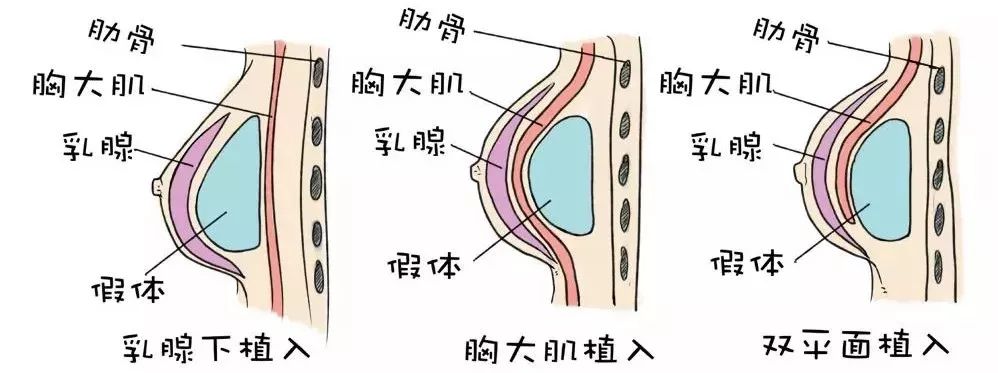 假体可以放在三种位置