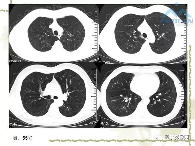 肺部弥漫性囊性病变的ct诊断影像天地
