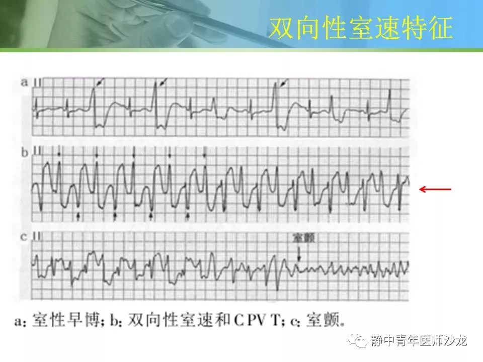 原创儿茶酚胺敏感性多形性室速一例