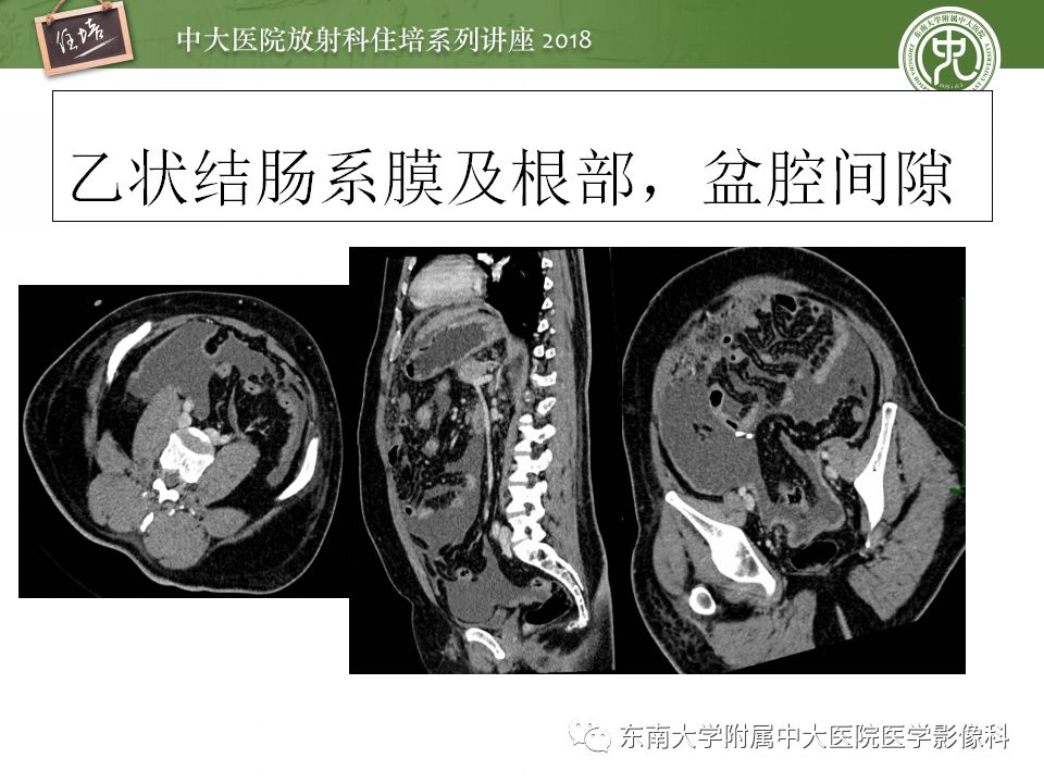 腹膜腹膜腔的影像解剖