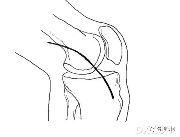 這份膝關節手繪圖譜，你一定不能錯過！ 健康 第13張