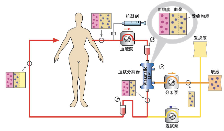 图4 双重滤过血浆置换法 ia在血浆置换的基础上,将高度特异性的抗原