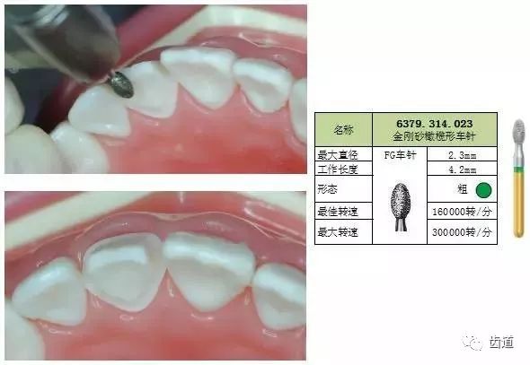 避免损伤附着龈. 采用金刚砂柱形圆头车针(最大直径1.