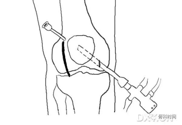 這份膝關節手繪圖譜，你一定不能錯過！ 健康 第21張