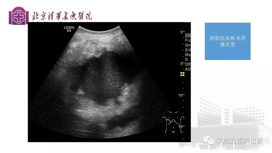 文献与病例学习:肝包虫病的超声诊断