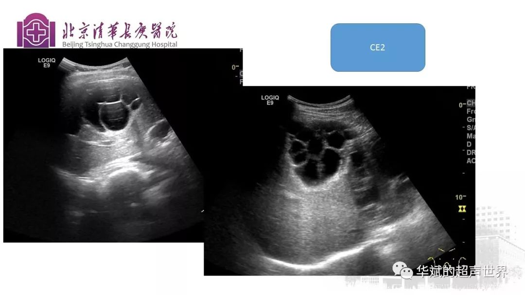 文献与病例学习:肝包虫病的超声诊断