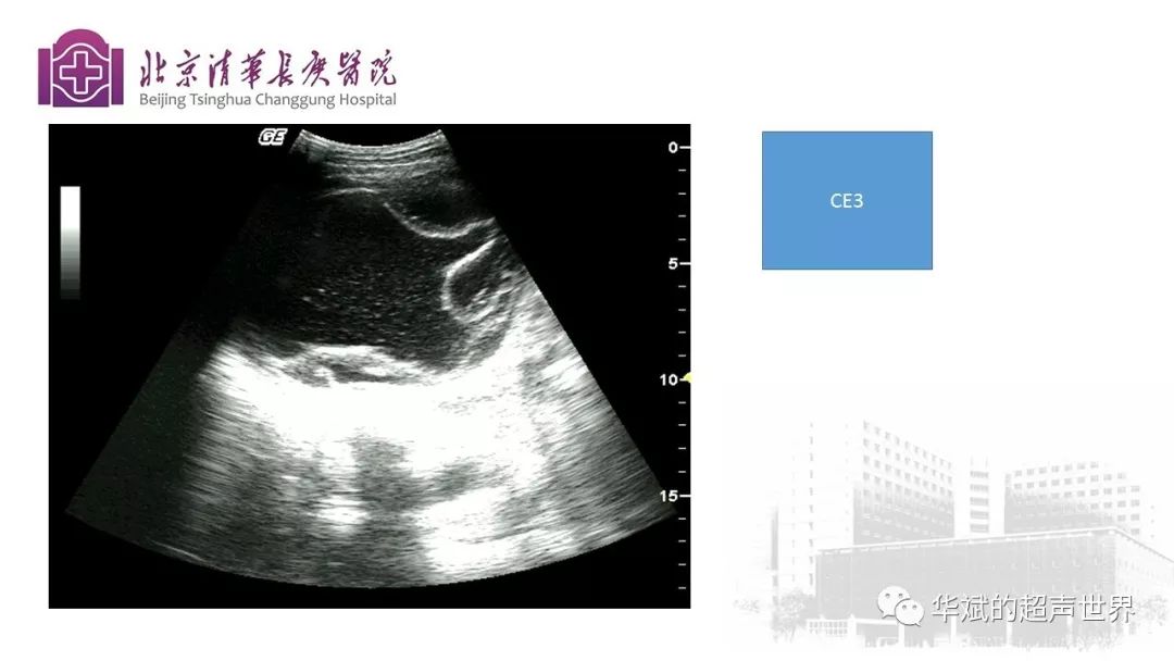 文献与病例学习:肝包虫病的超声诊断