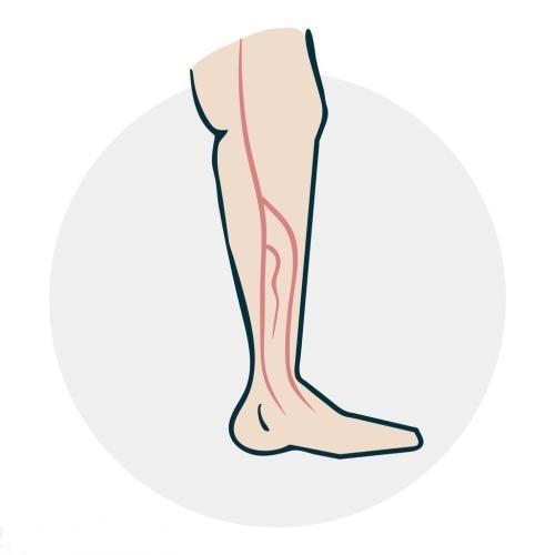腿部的静脉曲张需要怎么治疗 这些问题要了解 下肢