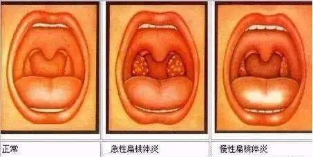 健康传递关于扁桃体的小秘密你get到了吗