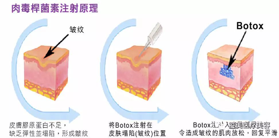 肉毒杆菌副作用较小,可能会引起短时的头痛,注射局部松弛,肌肉麻痹等