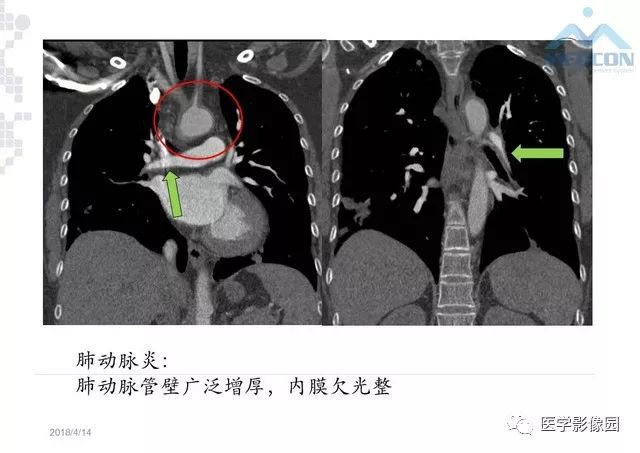 肺动脉高压放射影像学诊断与评价影像天地