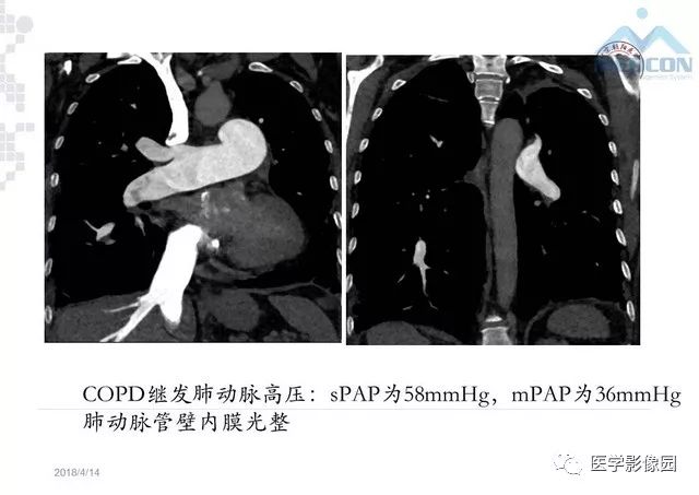 肺动脉高压放射影像学诊断与评价 | 影像天地