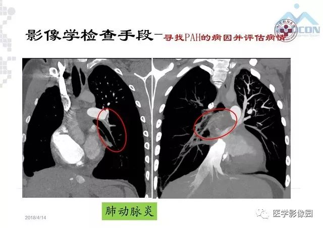 肺动脉高压放射影像学诊断与评价影像天地