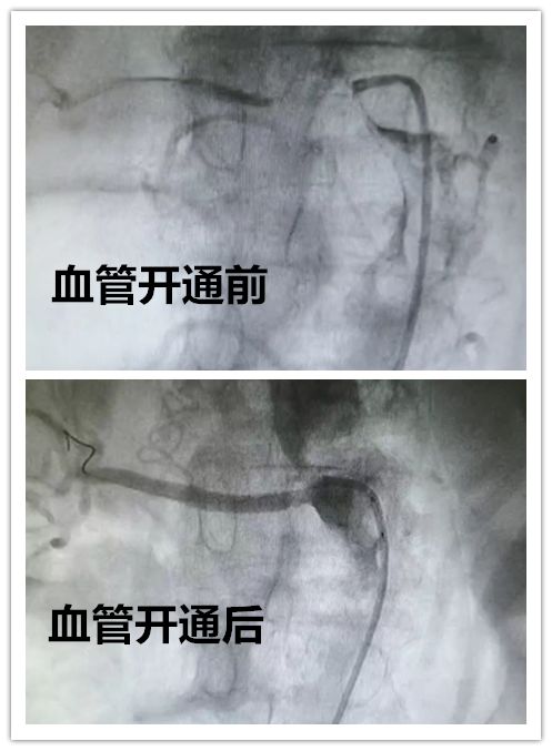 实施介入肾动脉造影,在患者双侧肾动脉不同程度严重狭窄情况下,为患者