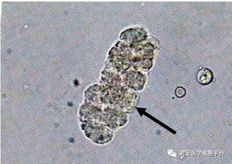 看图识细胞第32期2018年第2次浙江省体液形态学室间质评