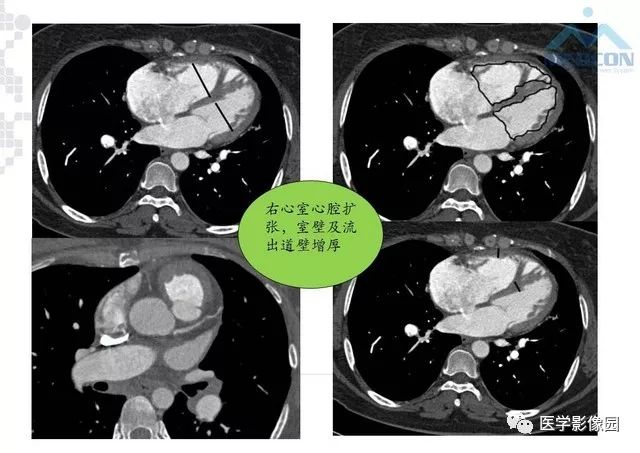 肺动脉高压放射影像学诊断与评价影像天地