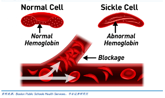 镰刀型细胞贫血症致病机制