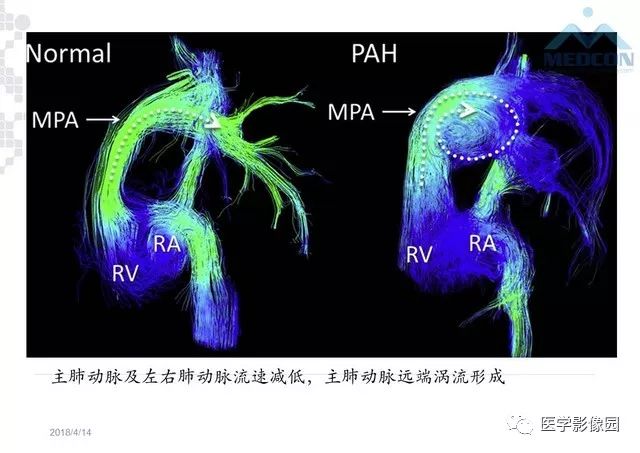 肺动脉高压放射影像学诊断与评价影像天地