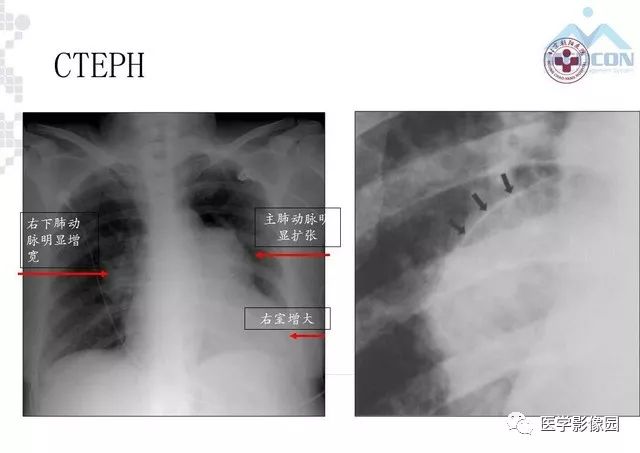 肺动脉高压放射影像学诊断与评价影像天地