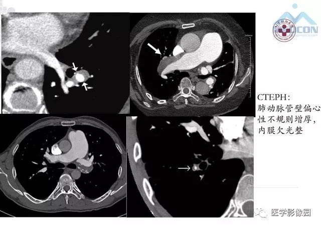 肺动脉高压放射影像学诊断与评价影像天地