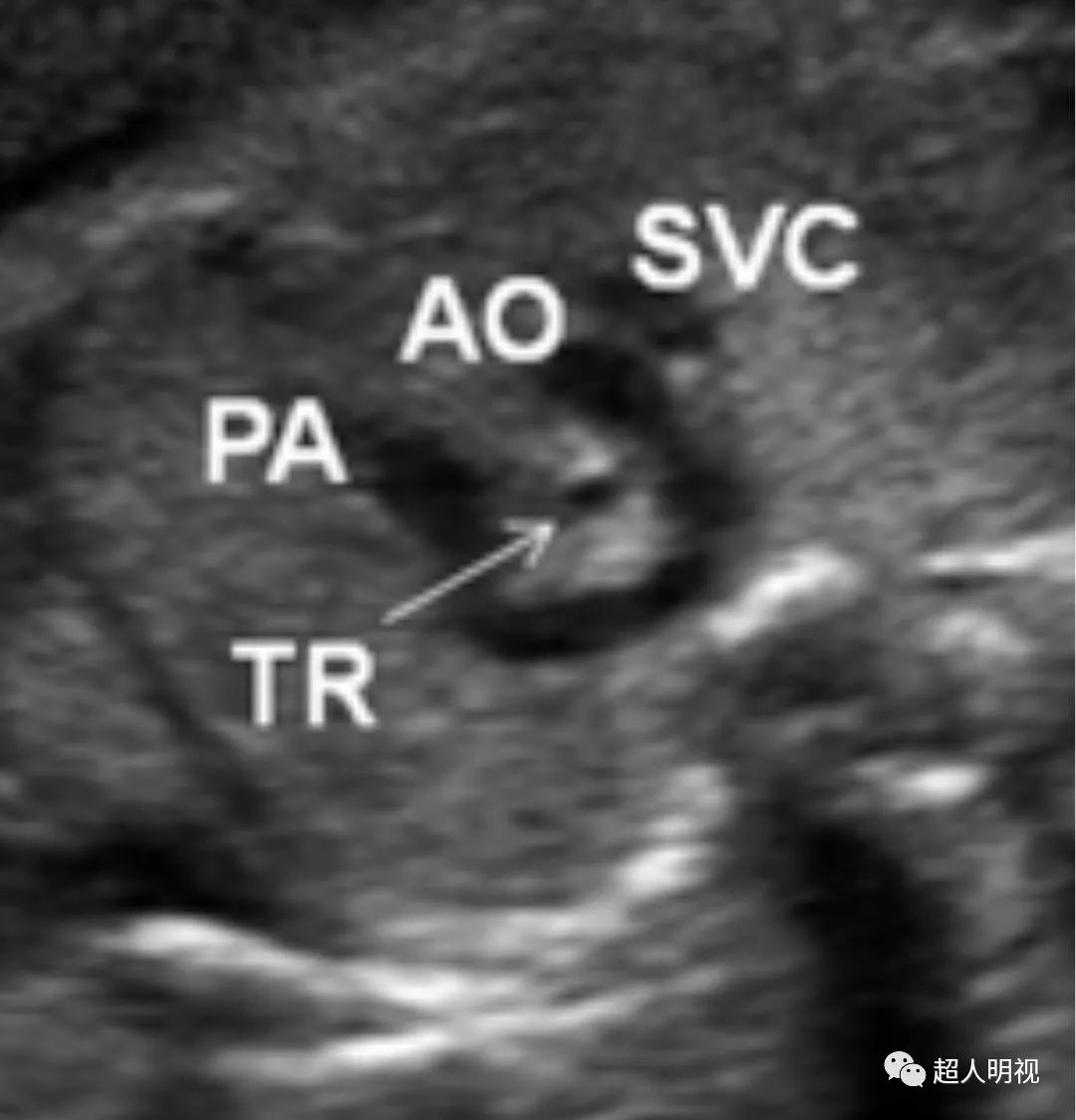 胎儿三血管气管切面重要在哪里