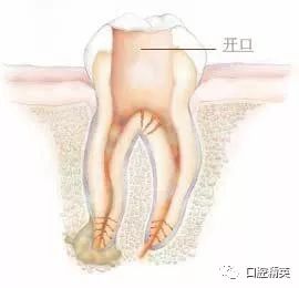 一看就懂:牙齿《根管治疗》全过程图解