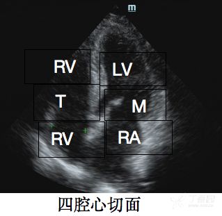 快速入门 | 3 点掌握心脏彩超读图技巧