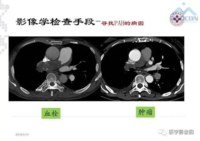 肺动脉高压放射影像学诊断与评价影像天地