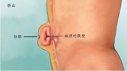 脐疝是指腹腔内容物由脐部薄弱区突出的腹外疝.