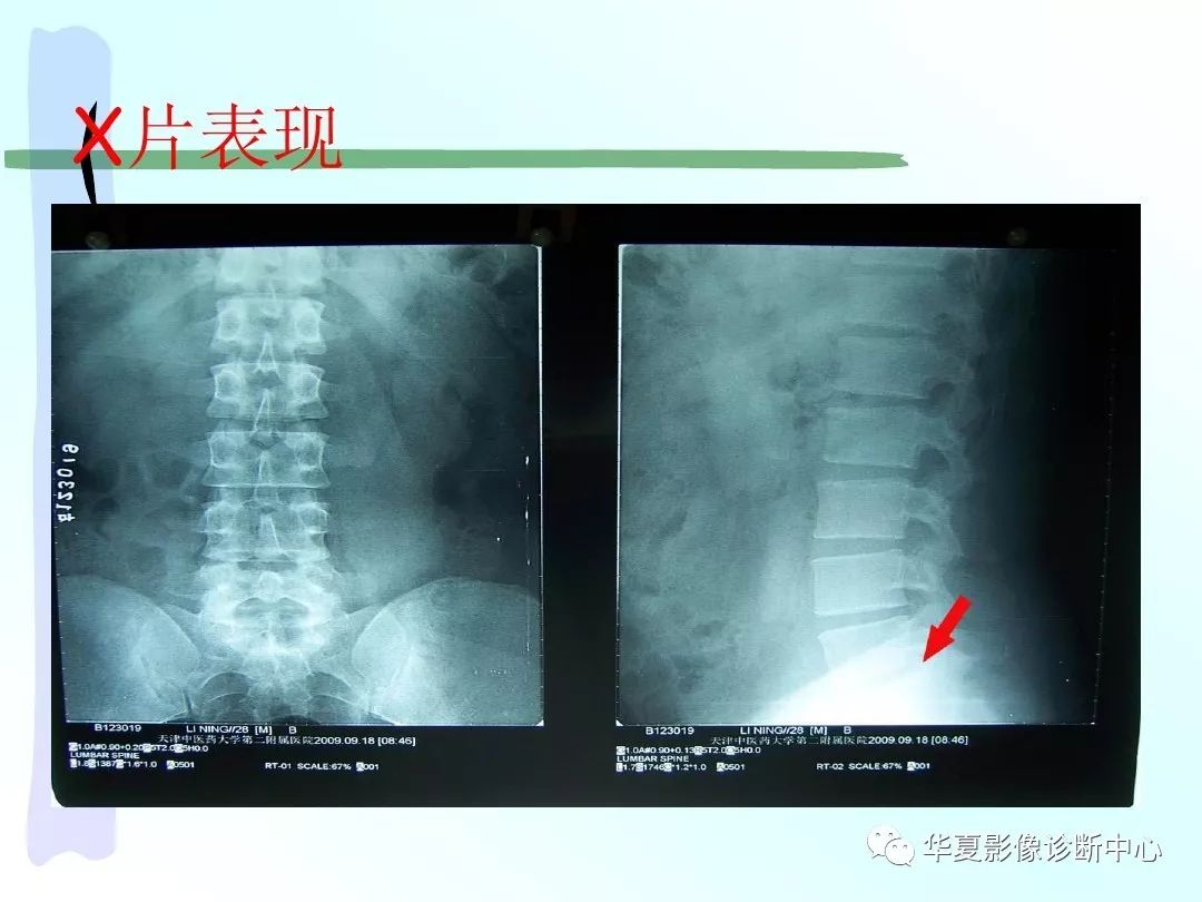 影像基础drx教你怎么看椎间盘突出