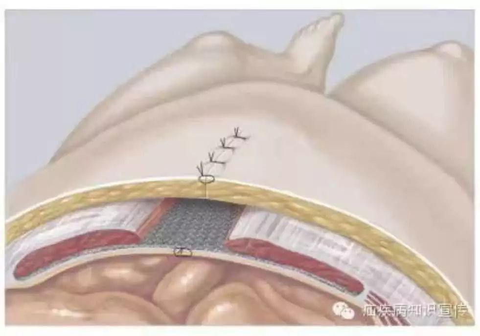 sublay法 名词解释 1,腹壁切口疝: 腹部术后,腹壁肌腱膜层愈合不良